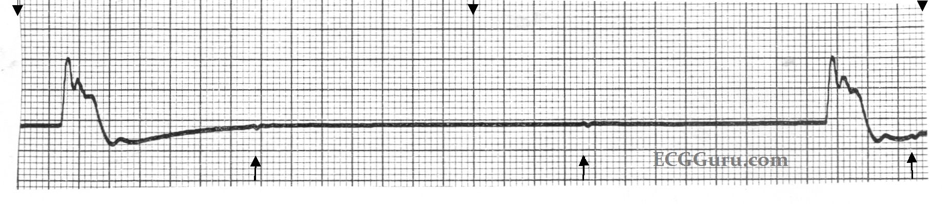 Female nude photography shaved Idioventricular rhythm strip